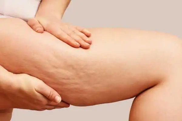 Image of woman showing leg with cellulite Broomhill
