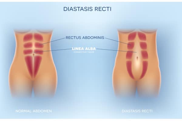 What Non-Surgical Options Are Available for Diastasis Recti Broomhill?