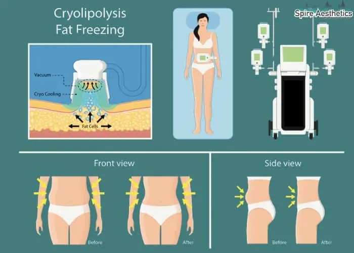 Fat freezing treatment Broomhill benefits for competitions to remove stubborn fat deposits.